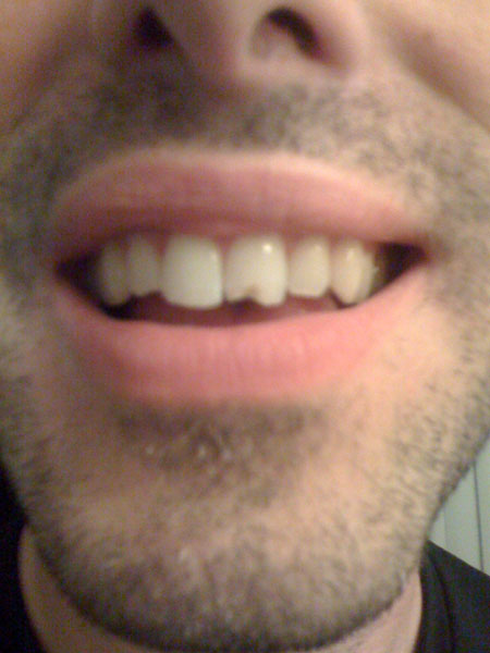 chipped_tooth.jpg